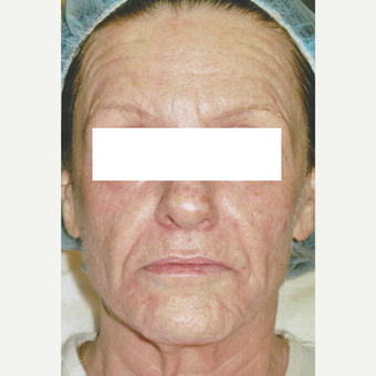 52 year old woman treated with Fraxel 1927, Botox, Fillers before 3055746