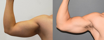 25-34 year old man treated with Vaser Liposuction before 4599326
