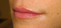 Lip Augmentation after 976122