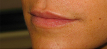 Lip Augmentation before 976122