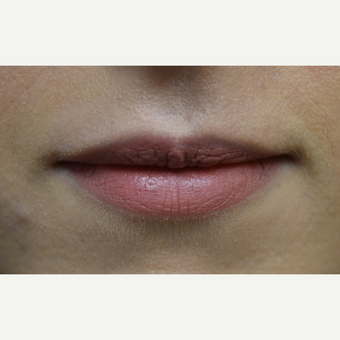 18-24 year old woman treated with Lip Augmentation before 3854689
