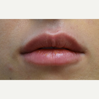 18-24 year old woman treated with Lip Augmentation after 3854689