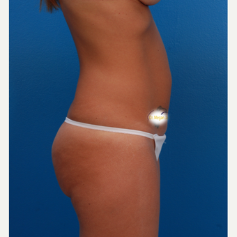 36 year old woman after 3 C-sections treated with Tummy Tuck for an improved abdominal shape. before 3280530