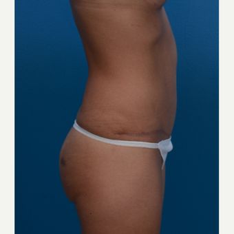 36 year old woman after 3 C-sections treated with Tummy Tuck for an improved abdominal shape. after 3280530