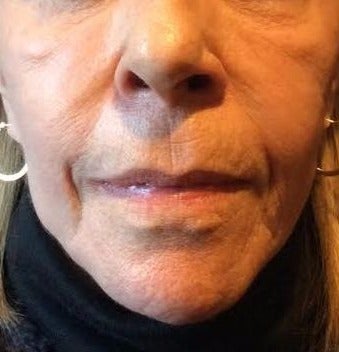 65-74 year old woman treated with Liquid Facelift before 3220477