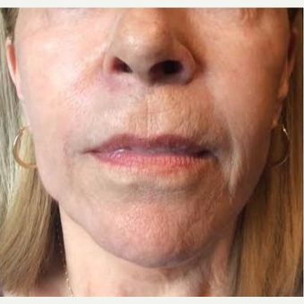 65-74 year old woman treated with Liquid Facelift after 3220477