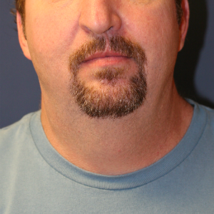 45-54 year old man treated with Neck Lift and Chin Implant before 3555296