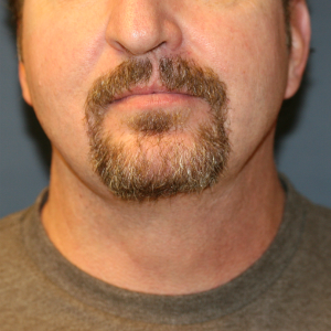 45-54 year old man treated with Neck Lift and Chin Implant after 3555296