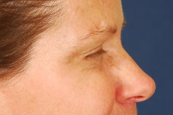 Botox Treatment of crow's feet after 492293