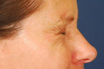 Botox Treatment of crow's feet before 492293