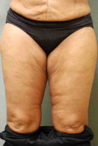 49 Year Old Female Smart Liposuction Performed for Excess Fat in the Thighs before 1046467