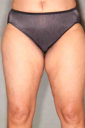 49 Year Old Female Smart Liposuction Performed for Excess Fat in the Thighs after 1046467