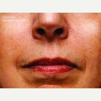 Bellafill Permanent Solution for Nasolabial Folds after 2988675