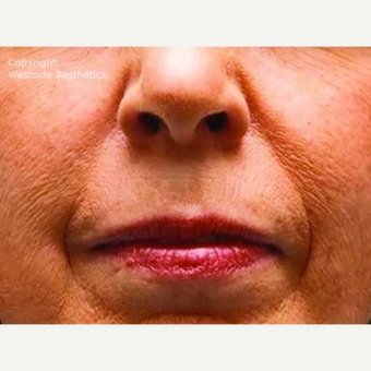 Bellafill Permanent Solution for Nasolabial Folds before 2988675