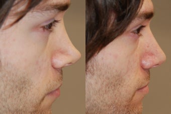Non-Surgical Rhinoplasty with Silikon-1000 for permanent results. before 216828