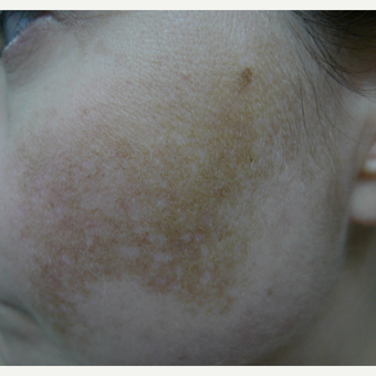 Melasma, lasers and creams before 3260222