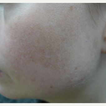 Melasma, lasers and creams after 3260222