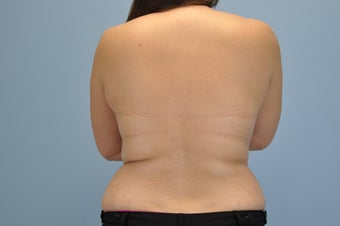 21 Year Old treated with VASER Shape before 1048386