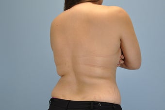 21 Year Old treated with VASER Shape 1048386