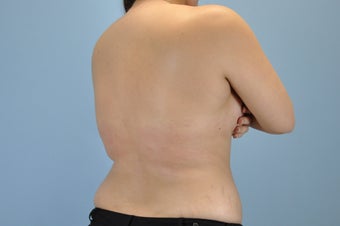 21 Year Old treated with VASER Shape 1048386