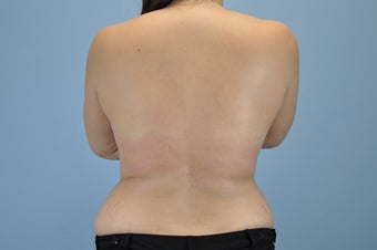 21 Year Old treated with VASER Shape after 1048386