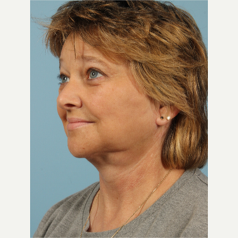 55-64 year old woman treated with Facelift after 3617690