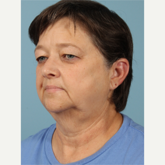 55-64 year old woman treated with Facelift before 3617690