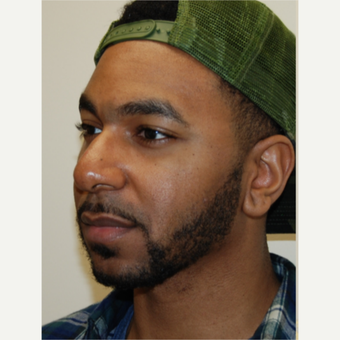 25-34 year old man treated with African American Rhinoplasty before 2980770