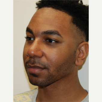 25-34 year old man treated with African American Rhinoplasty after 2980770