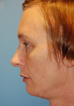 Transgender surgery after 1454199