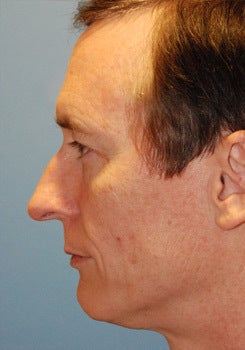 Transgender surgery before 1454199