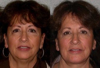 55-64 year old woman treated with Facelift before 3615766