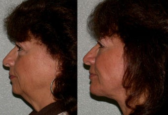 55-64 year old woman treated with Facelift after 3615766