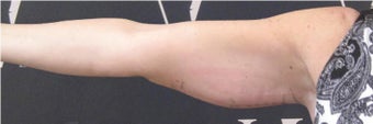 Non-Surgical Fat Reduction of the Upper Arms by CoolSculpting before 3297633