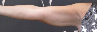 Non-Surgical Fat Reduction of the Upper Arms by CoolSculpting after 3297633