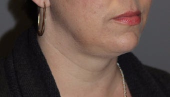 35-44 year old woman treated with Kybella after 3147397