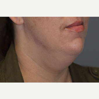 35-44 year old woman treated with Kybella before 3147397