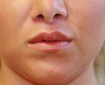 Lip Lift San Diego (permanent lip enhancement) after 1151947