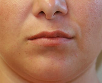 Lip Lift San Diego (permanent lip enhancement) before 1151947