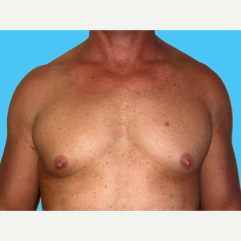 Pec Implants before 3831945