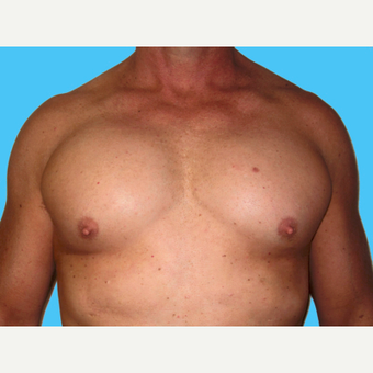 Pec Implants after 3831945