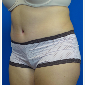 35-44 year old woman treated with Tummy Tuck after 3769550
