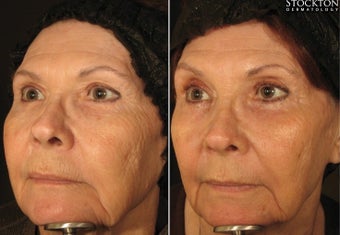 55-64 year old woman treated with Fractional Laser 1540/2940 before 2094180