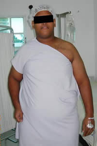 21 year old male Morbidly obese before 1092927