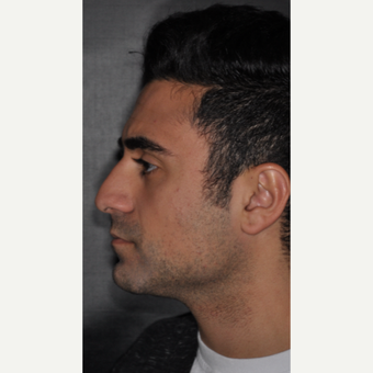 18-24 year old man treated with Septoplasty 6 weeks post-op before 3500177