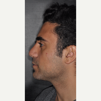 18-24 year old man treated with Septoplasty 6 weeks post-op after 3500177
