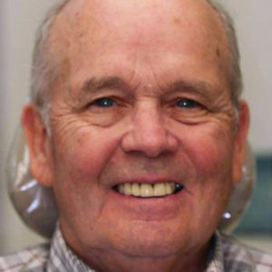 Hybrid denture on dental implants before 3696578