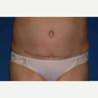 55-64 year old woman treated with Tummy Tuck after 3009783