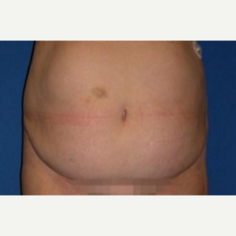 55-64 year old woman treated with Tummy Tuck before 3009783