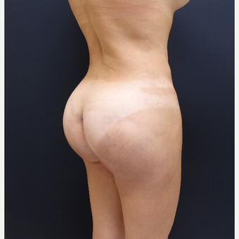 35-44 year old woman treated with Brazilian Butt Lift Revision after 3234479